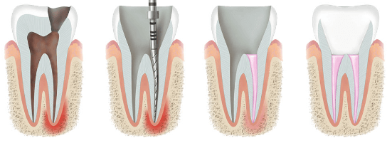Leczenie endodontyczne - co to jest i i le kosztuje?
