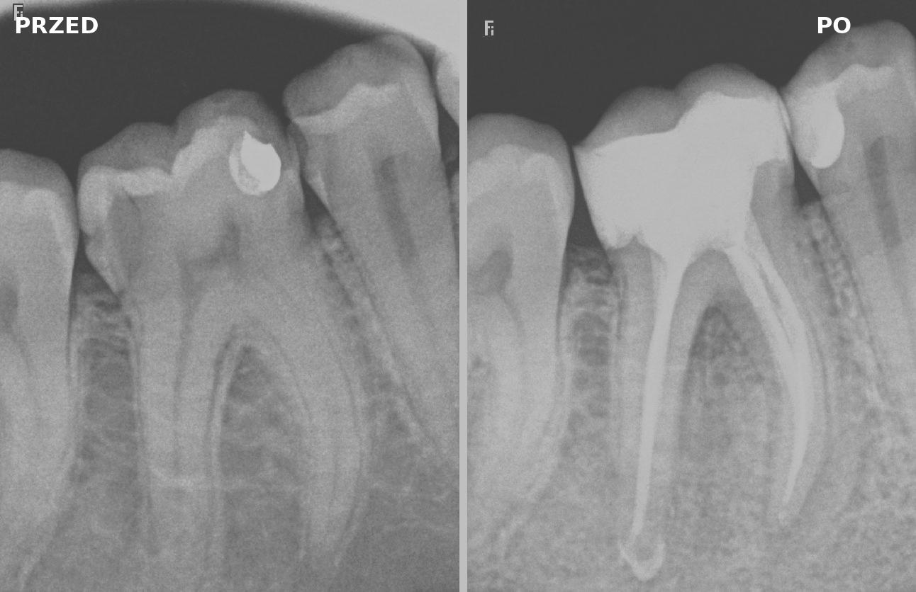 Protezy zębowe szkieletowa