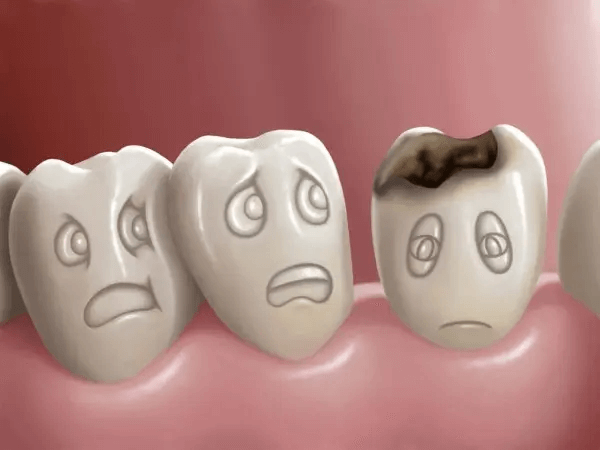 profilaktyka próchnicy zębów