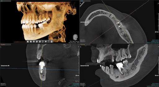 CBCT- co to takiego?