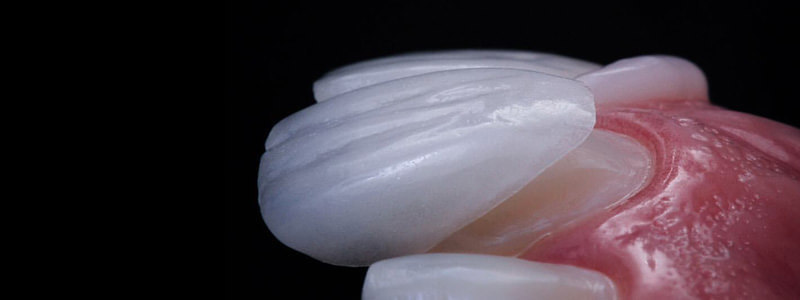 Licówki – szybka droga do pięknego uśmiechu.