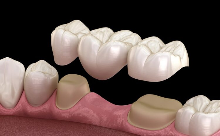 Mosty protetyczne- nowoczesna i trwała odbudowa brakujących zębów.