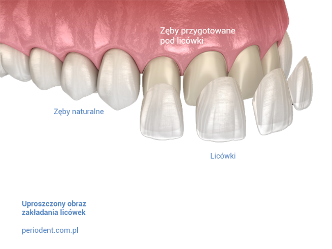 Zeby pod licówki
