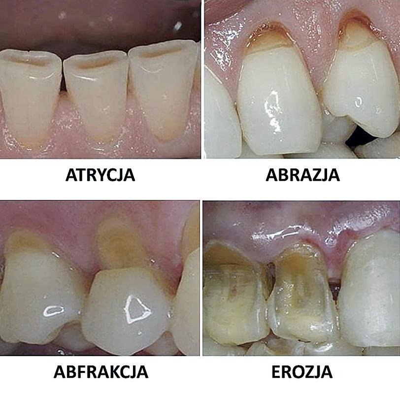 Atrycja, abrazja, abfrakcja, erozja