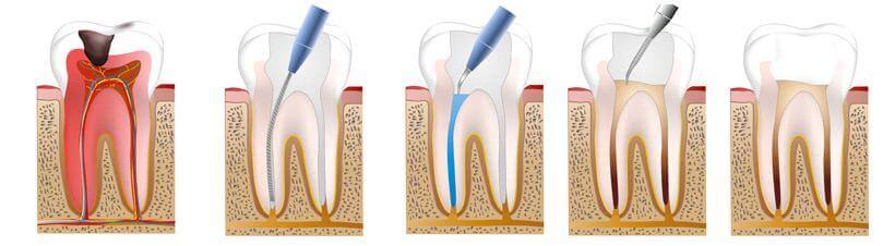 endodoncja zębów