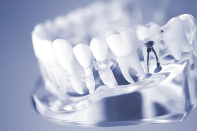 Kanały zęba - leczenie endodontyczne