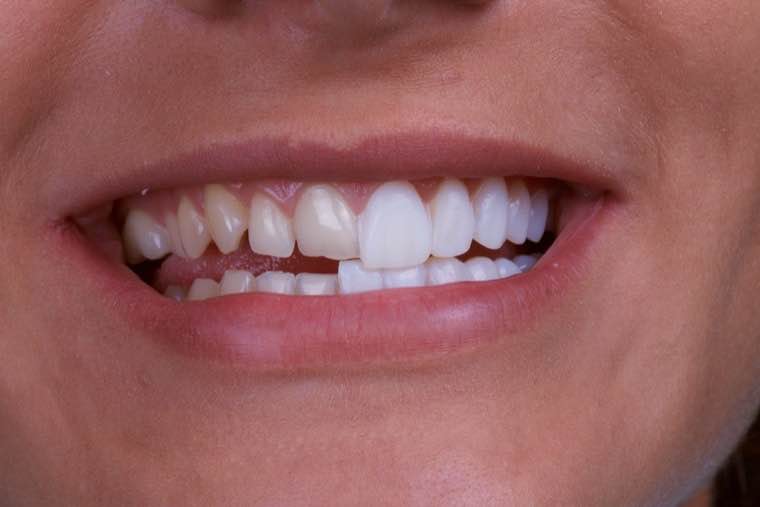 Licówki porcelanowe – estetyka, trwałość i nowoczesna stomatologia