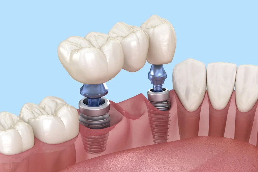 Most na implantach vs most na zębach własnych - co wybrać?