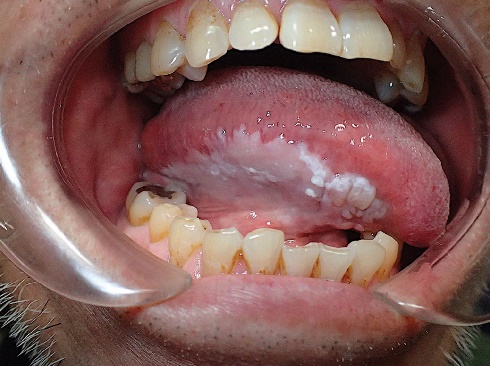  Leukoplakia leczenie