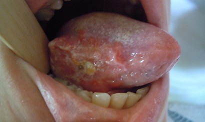 Leukoplakia zmiany