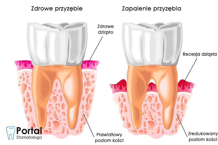 profilaktyka próchnicy zębów przy paleniu