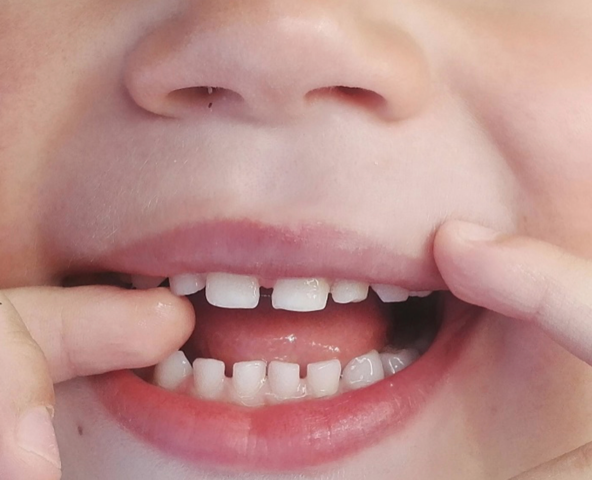Zęby u dziecka