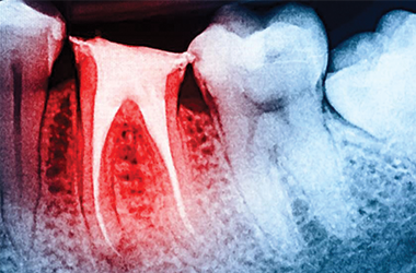 Endodoncja