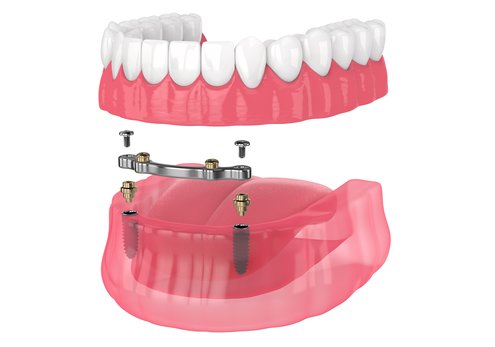 Protezy overdenture na implantach- wszystko, co musisz o nich wiedzieć!