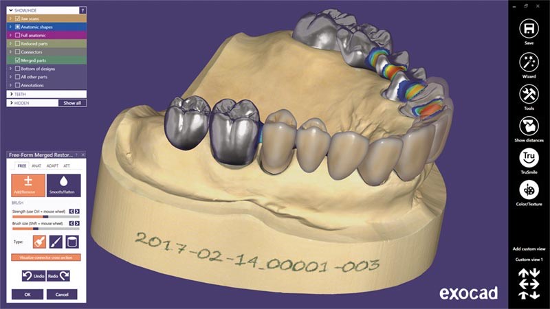 Exocad Allecoudent