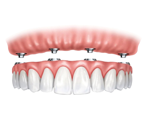 Most na 4 lub 6 implantach