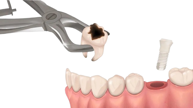 Natychmiastowy Implant