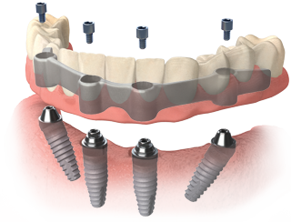 Overdenture na belce