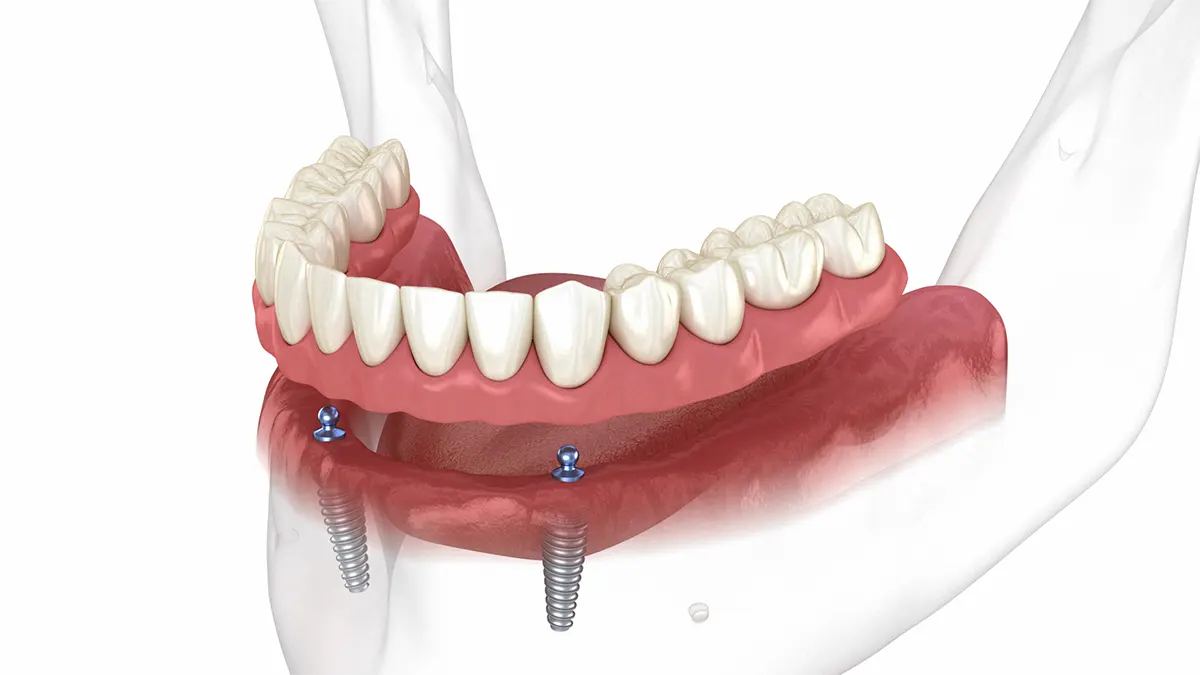 Proteza Overdenture
