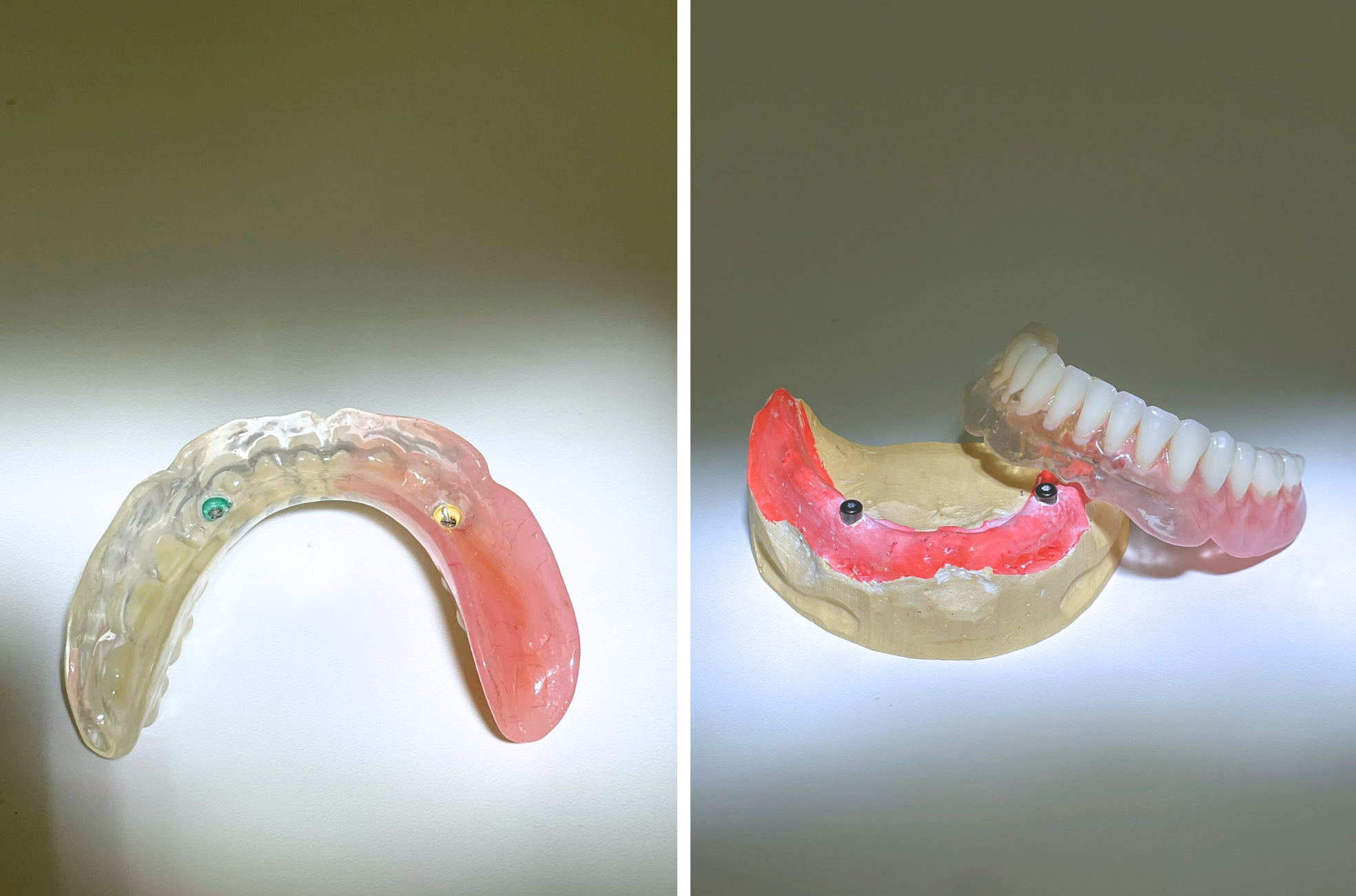 Proteza Overdenture