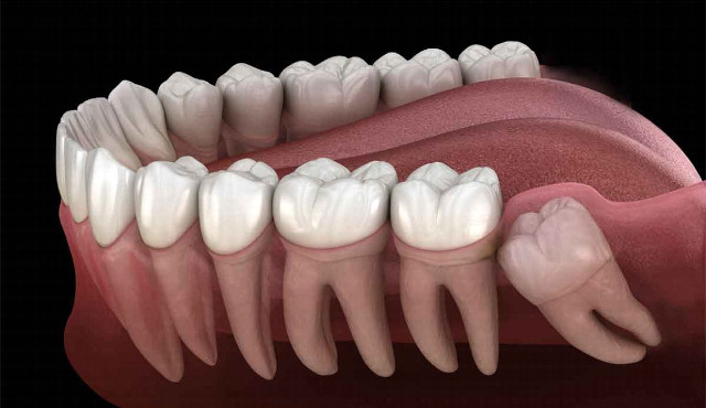 chirurgiczne usuwanie zębów poznań