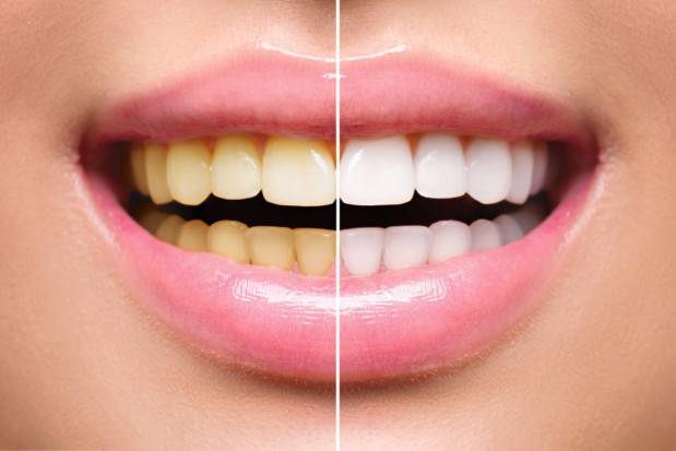 Wybielanie zębów Poznań - bezpieczny, profesjonalny zabieg w Allecou Dent